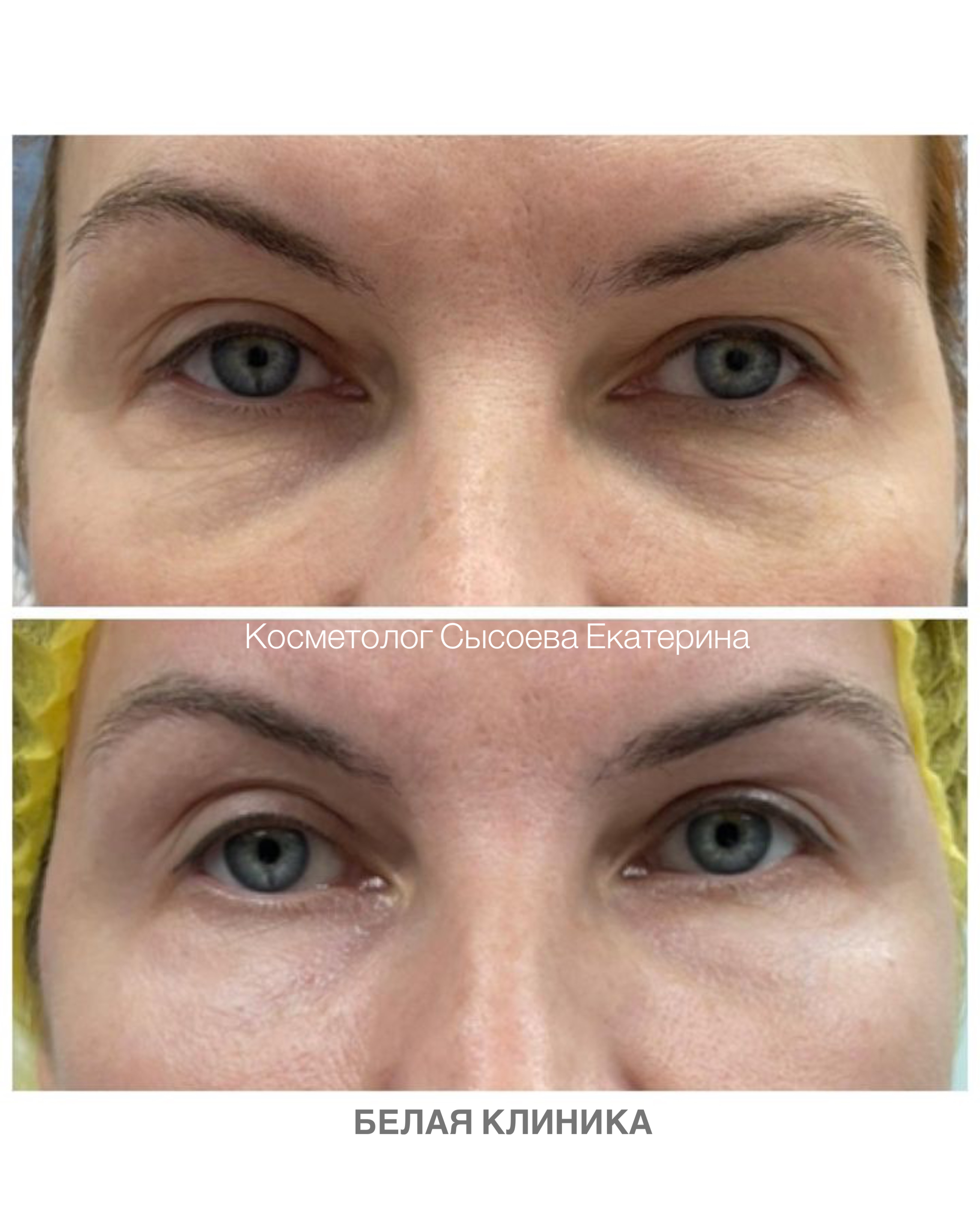 СО2-лазерное омоложение